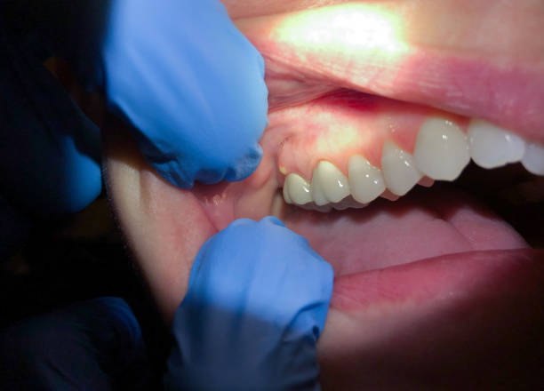 Best Emergency Tooth Extraction in Ranchettes, WY